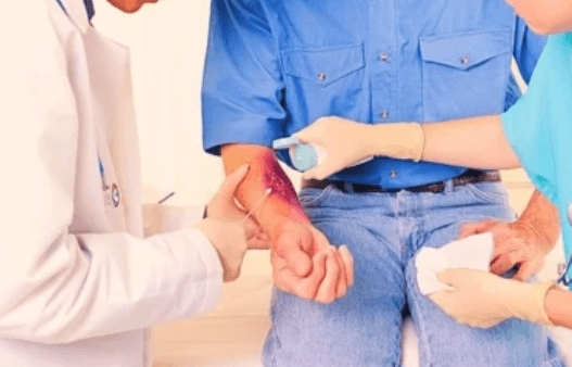 How Legal Help Can Strengthen a Burn Injury Case